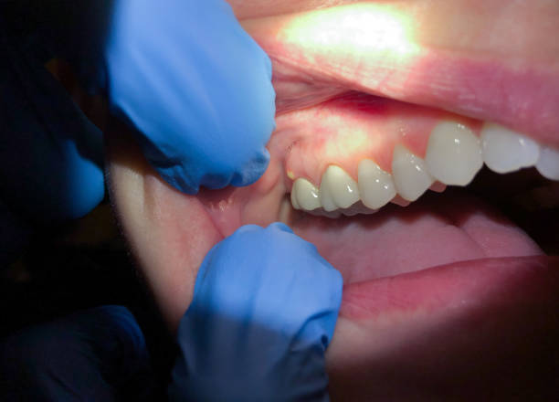 Best Teeth Whitening  in Ciborne, LA